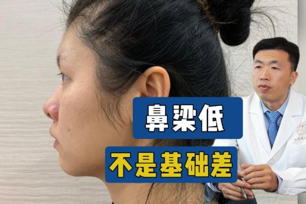 低鼻梁怎么办