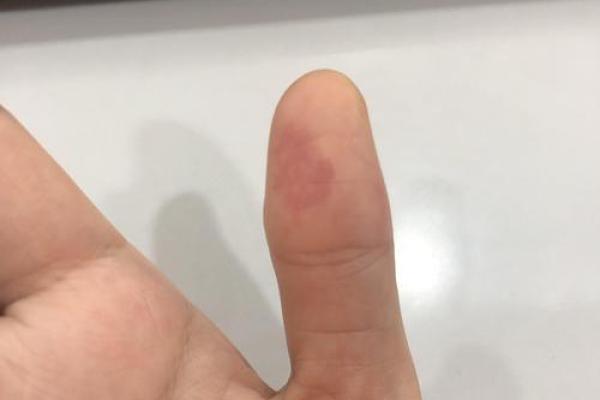 风水学上胎记中的有说明什么