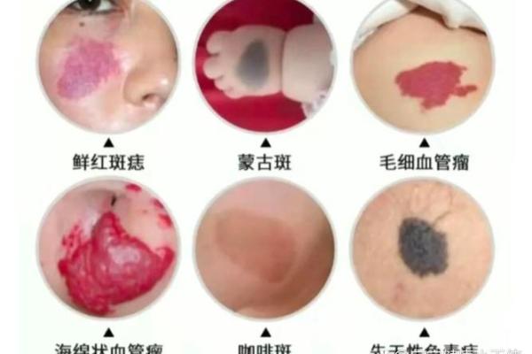 红胎记算命图解