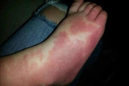 人体胎记算命的解释分析