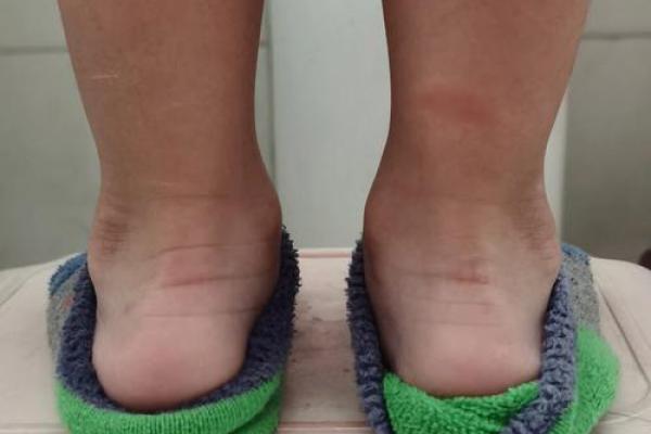 儿童内八字脚 儿童内八字脚