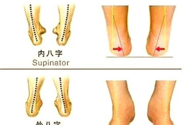 八字脚是什么
