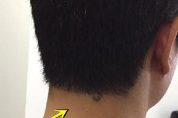 风水上后脑勺长痣代表什么意思 风水上后脑勺长痣代表什么意思