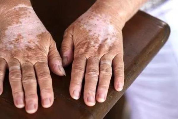 白色胎记算命分析