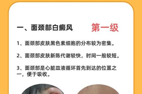 白色胎记算命分析