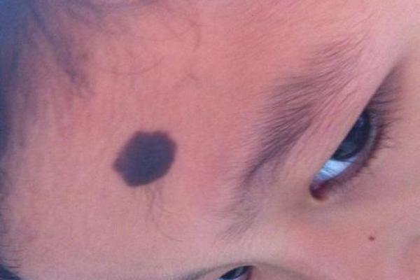 面部不同位置的胎记算命