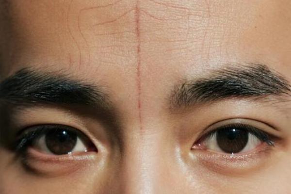 额头上的胎记算命 额头上的胎记算命