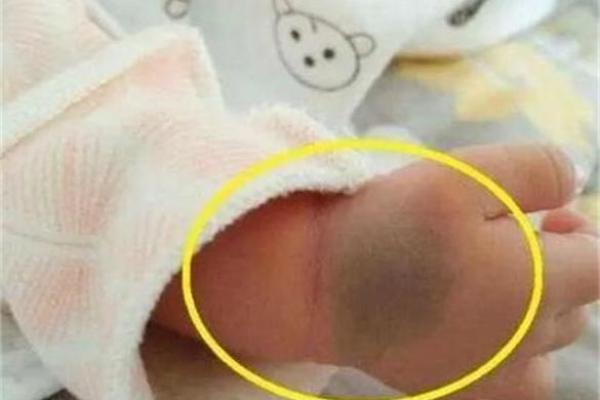 屁股有胎记算命分析