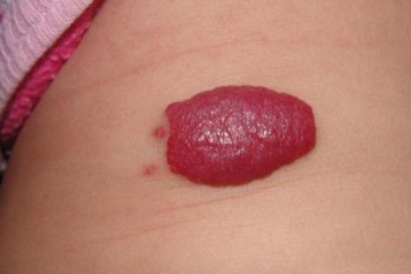 胎记算命：最好胎记长什么部位